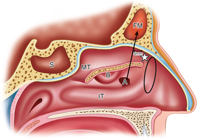 Pathologies du sinus frontal