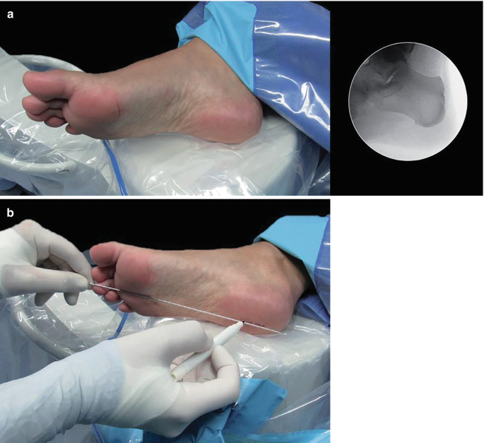 Bangkok Post - Step into the future with minimally invasive foot and ankle  surgery