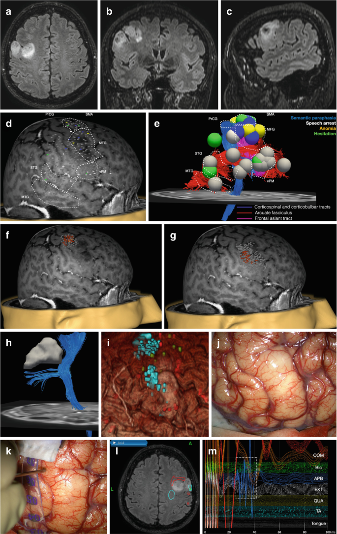 Perioperative Glycemia Management in Patients Undergoing Craniotomy for  Brain Tumor Resection: A Global Survey of Neuroanesthesiologists'  Perceptions and Practices - ScienceDirect