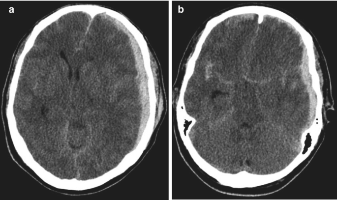 The image of C T head with a hyperdense area on the right side in the inside region of the skull. In part b, the hyperdense region is slightly outside the skull area and the cerebrum is visualized.