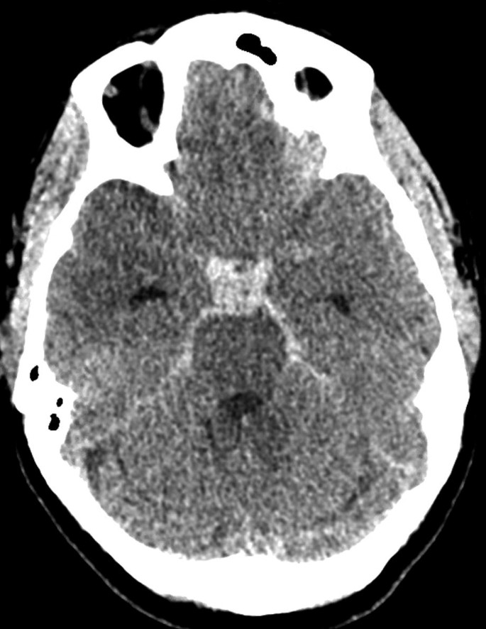 A non-contrast C T head with Aneurysmal subarachnoid hemorrhage and a blurred region with the hemorrhage seen outside the skull margins on both sides.