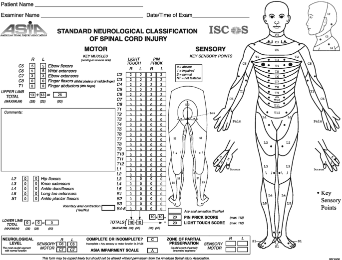 An image of the A S I A examination form. Upon diagnosis, the patient has injury throughout his spine. A S I A classifies the injury under Grade A of the impairment scale. Values 0, 1, 2, N T are represented as absent, impaired, normal and not testable respectively. A score of P I N P R I C K and L I G H T T O U C H are mentioned.