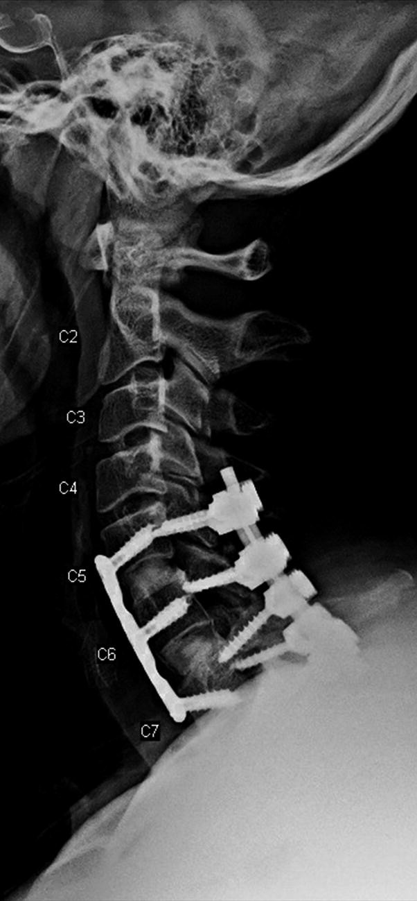 An X ray image of the cervical spine, in lateral view. The dislocations in C 5, C 6, and C 7 are secured by fixations.