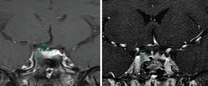 Image of two scans of the brain. The scans show a hypointense right-sided lesion. In the first scan, its size is 7.71 millimeters and 6.52 millimeters. In the second scan, its size is 3.27 millimeters and 6.32 millimeters.