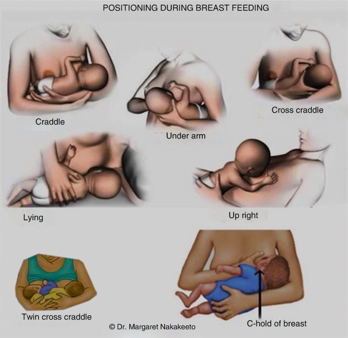 Breastfeeding Support Devices in Low-Resource Settings