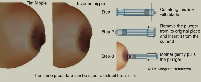 Breastfeeding With Inverted Nipples (15 Tips and Tricks) — Milkology®