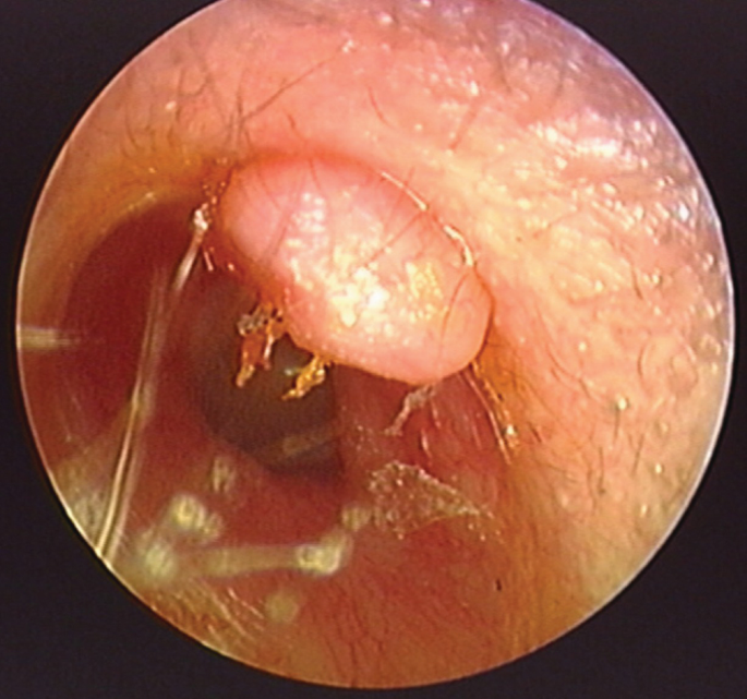 Diseases of the External Auditory Canal