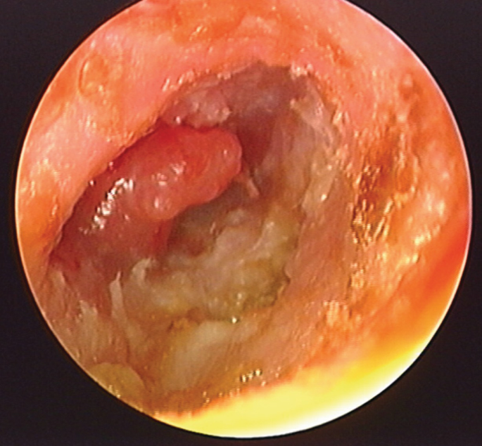 malignant otitis externa granulation tissue
