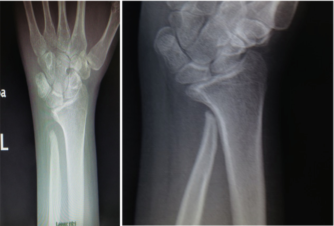 A set of two X-rays depicts the anteroposterior and lateral views of the wrist with the dislocation of bones.