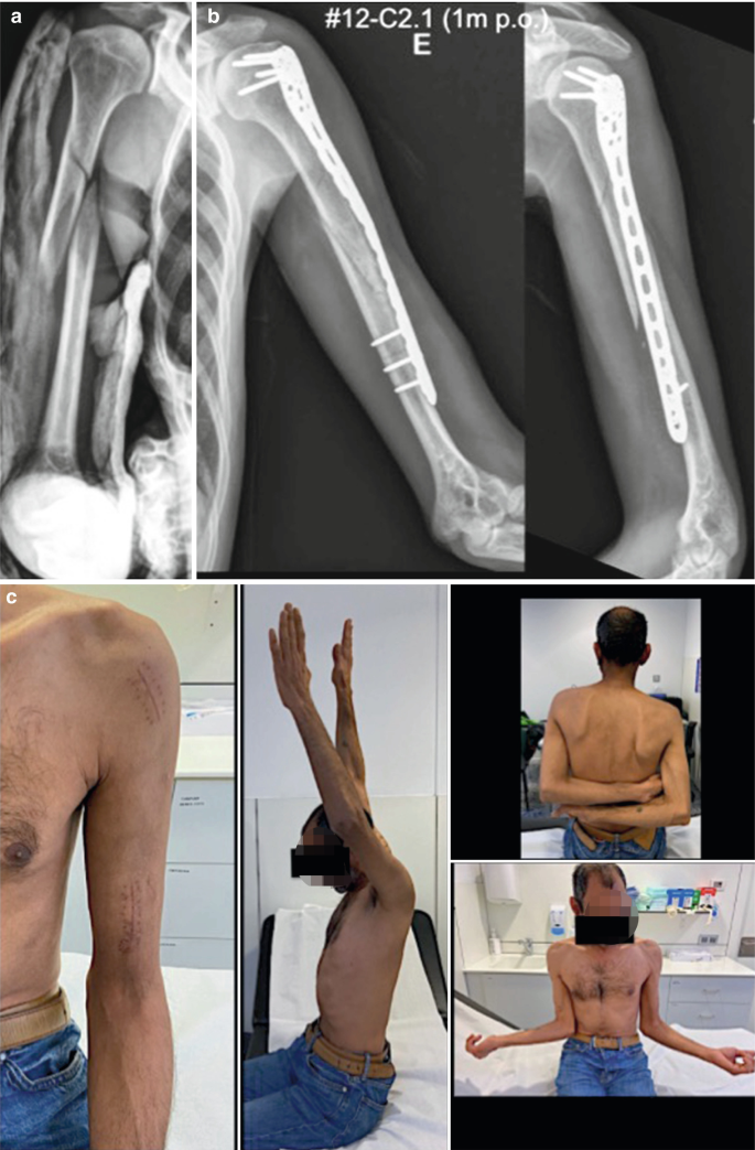 Photographs a and b represent a diaphyseal proximal humerus fracture and post-operative healing. The other four photographs represent physiotherapy activities.