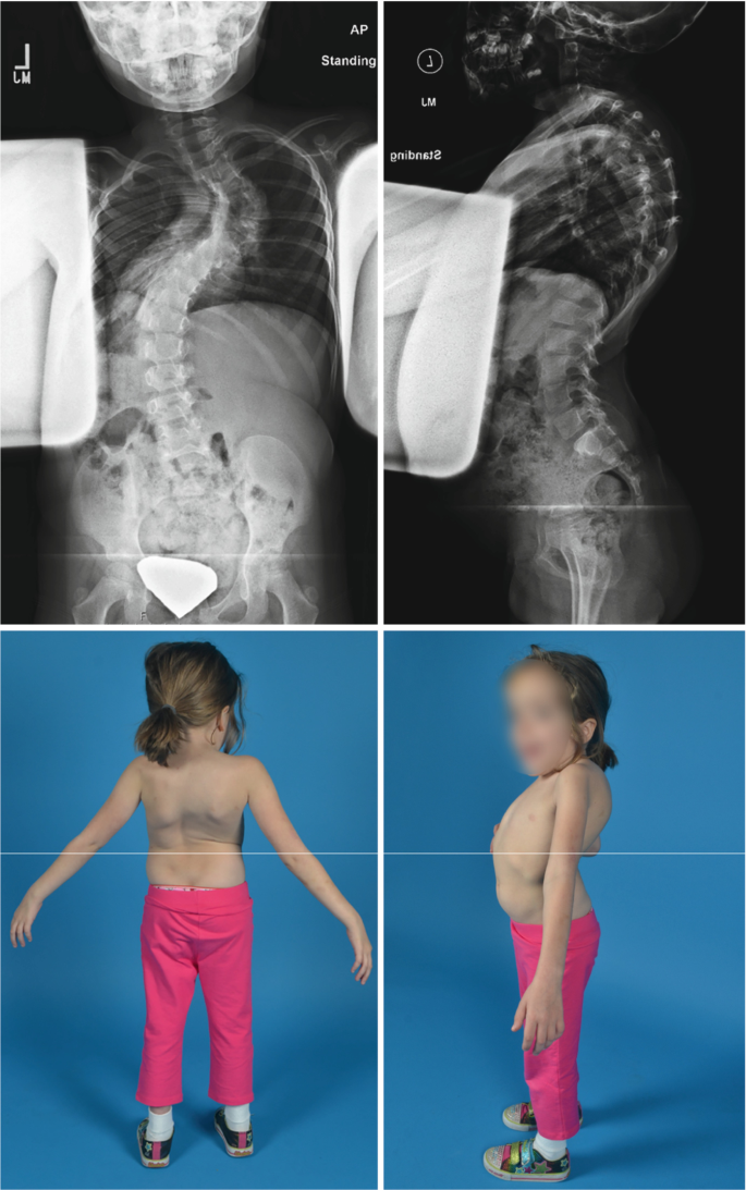 Scoliosis in Children