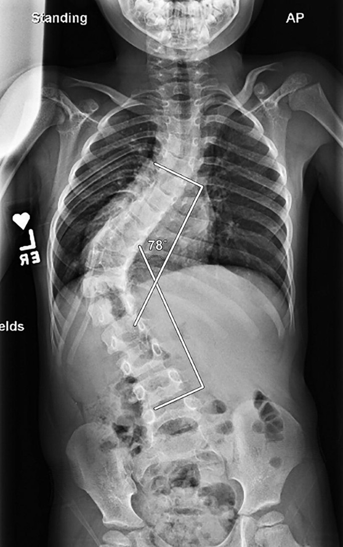 Boston Brace: First Check before X-Ray - Scoliosis and Spine Online Learning