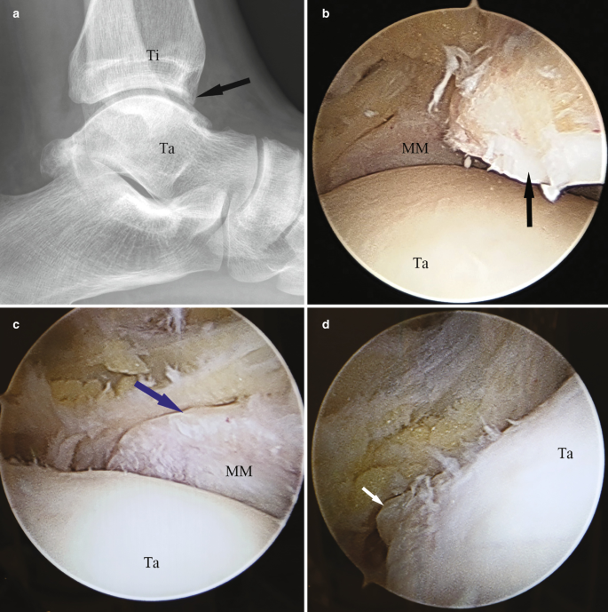 An x-ray and 3 endoscopic images of the tissues around the talus also reveal the medial malleolus with a bony lump of cells.