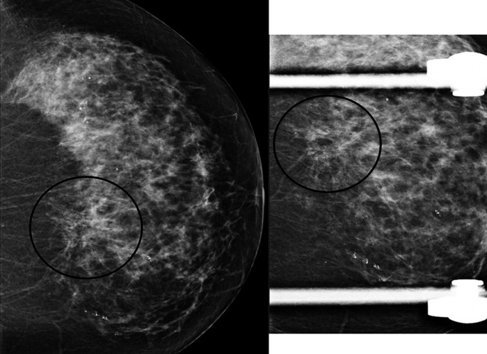 Courtesy ref no-6-Triple-negative invasive breast cancer demonstrating