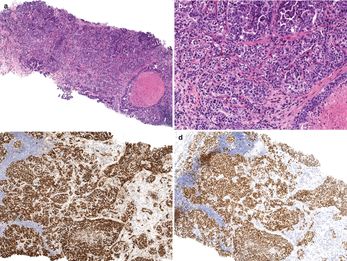 Invasive carcinoma of no special type - Wikipedia