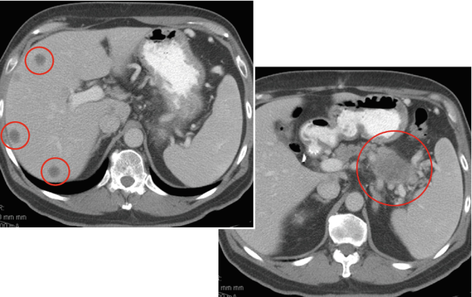 Two contrast-enhanced C T scans. The C T scan on the left depicts three encircled areas that mark the hypodense prominence of the pancreatic head on its left, while the right image encircles the tumor that rises from the tail of the pancreas.