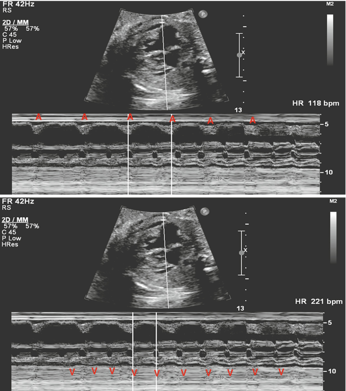 Doppler Echocardiography of Fetal Cardiac Arrhythmias | SpringerLink