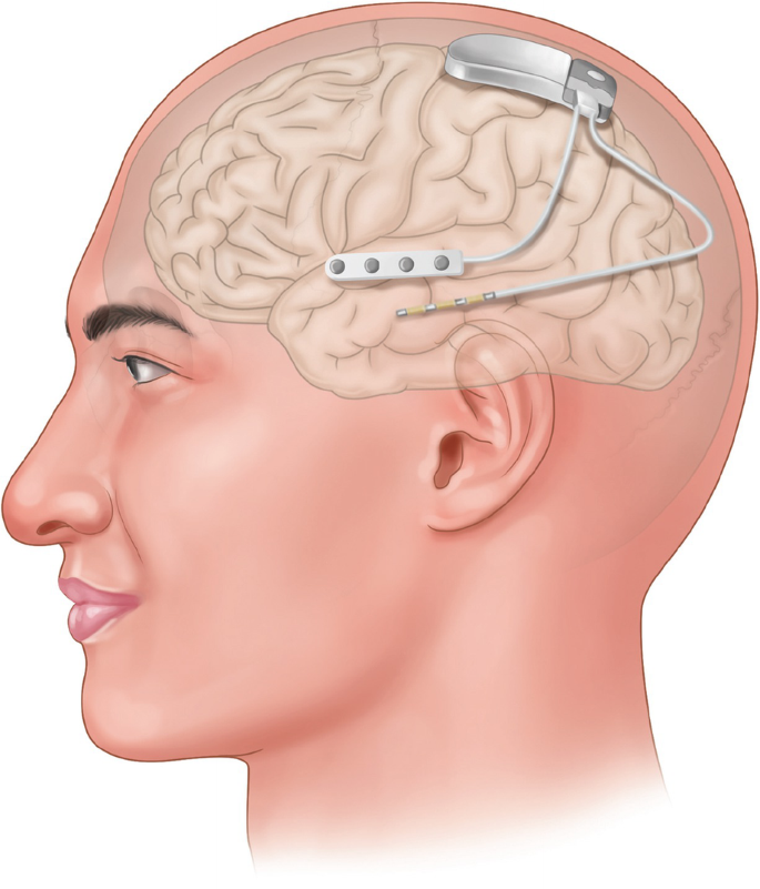 First human implantation of the WFMA for intracortical visual