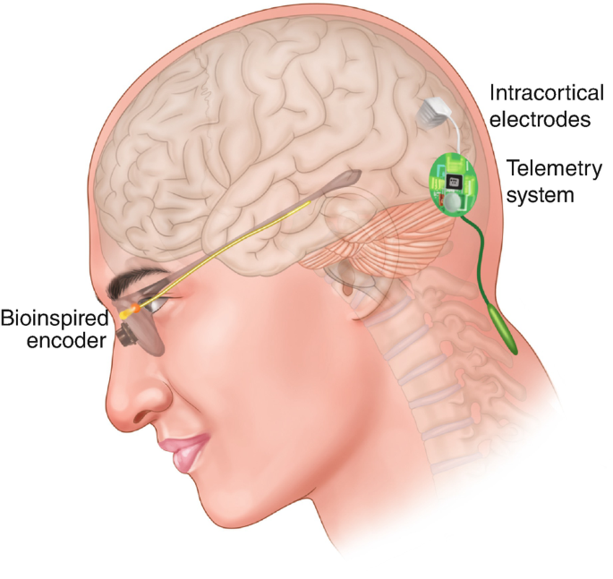 First human implantation of the WFMA for intracortical visual prosthesis -  Microprobes for Life Science