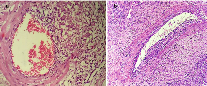 Pathology of Tuberculosis | SpringerLink