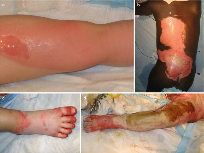 A set of 4 close up photos of severe deep burns in children. Photos A to D present the burn locations on the thigh, back, foot, and leg, respectively.