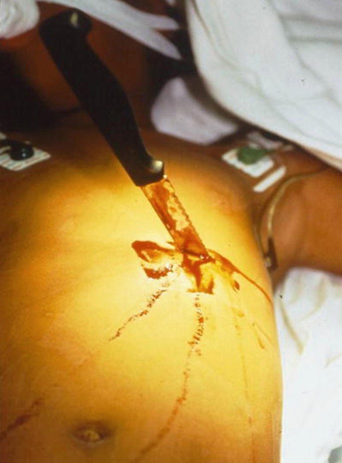 A photo of a knife stabbed inside the thoracic cavity just above the abdomen.