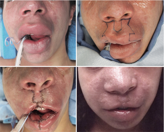 Four photographs of capillary vascular malformation of the lips indicate pre and post operative appearances. A pre operative photograph has incision marks.