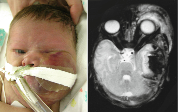 A photograph of a child treated with vincristine, steroids, and interferon alpha. Left facial palsy with cross-facial nerve graft and free gracilis muscle transfer is observed.