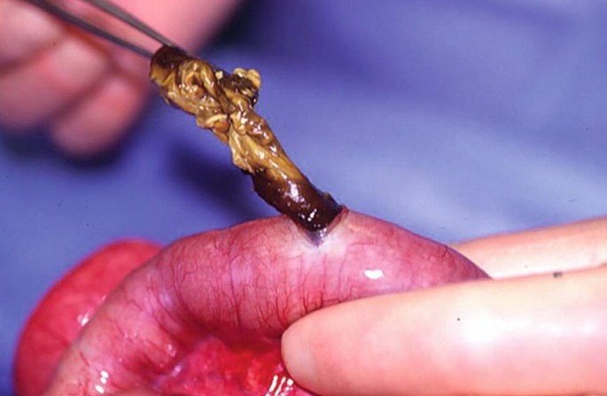 A close-up photo of the meconium being pulled out from the inside of the ileum with the help of a pair of forceps through a small incision.