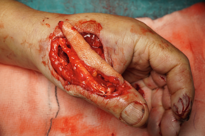 A photograph of an injured thumb has the tendon which is below the flap and is placed on to the injured thumb.