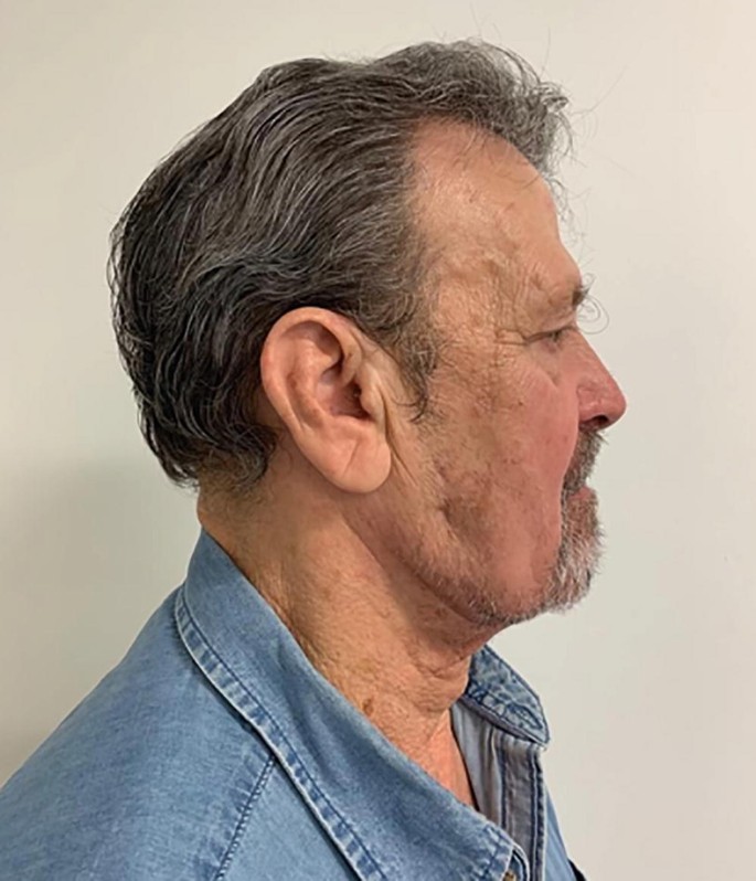 A Post-operative photograph of the side view of a person facing the right.