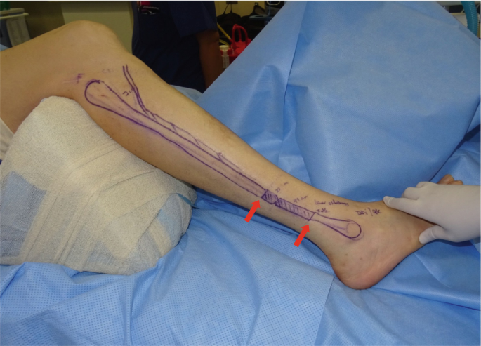 A photograph of a patient's leg with the fibula bone is drawn on the skin. A segment of the bone above the ankle is hashed, which denotes the damaged region where the bone slightly narrows at a point.