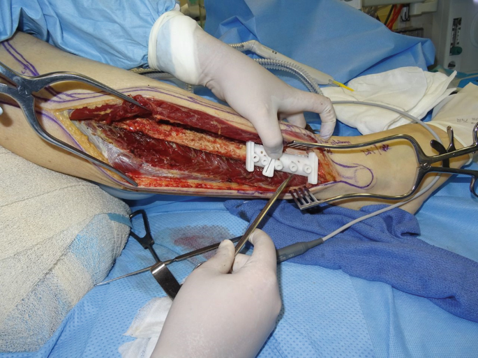 A surgical photograph where a patient's epidermis, followed by the fibula bone, is exposed. A medical expert who wears a glove attaches a clamp-like structure at the fibula bone above the ankle, and other tools expand the muscle.