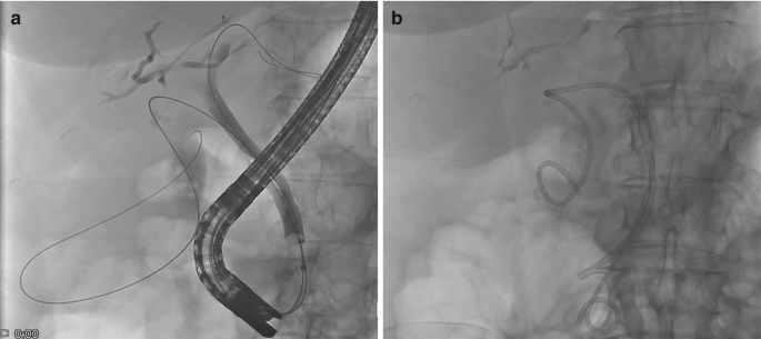 The figure depicts the stent placement in gall bladder a) depicts the use of two guidewires. one is coiled in the body of the gallbladder and second is in the left hepatic duct. b) depicts a double-pigtail plastic stent in the gallbladder. A second plastic stent is in the common bile duct.