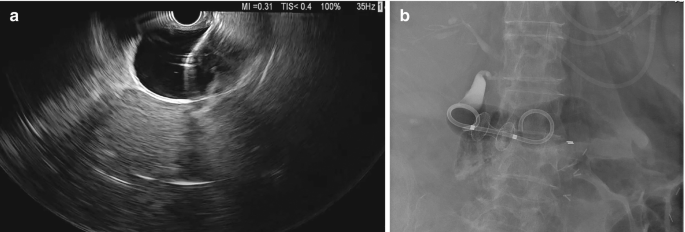 An illustration of an ultrasound image in fig a illustrates where the stent is placed and that is highlighted. In fig b, the angiogram image views the graft as implanted in an organ. It has a faded background with graft.