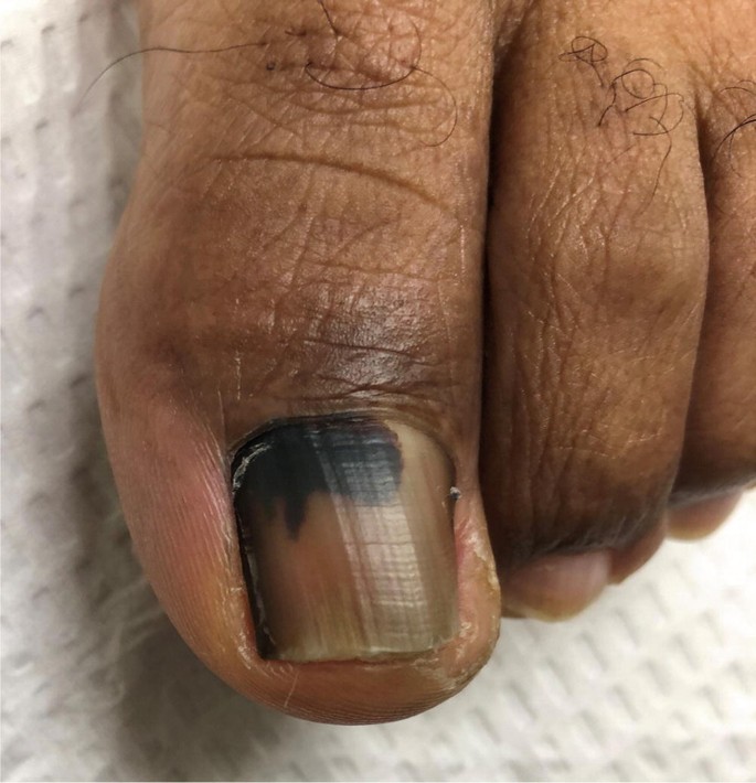 Pigmented lesion on nail bed: Pseudo-Hutchinson sign | Cleveland Clinic  Journal of Medicine
