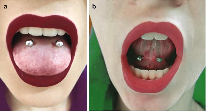 Coated tongue: Symptoms, causes, treatment | CURAPROX