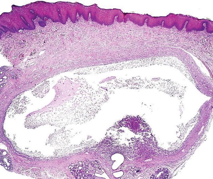 Swellings of the Tongue | SpringerLink