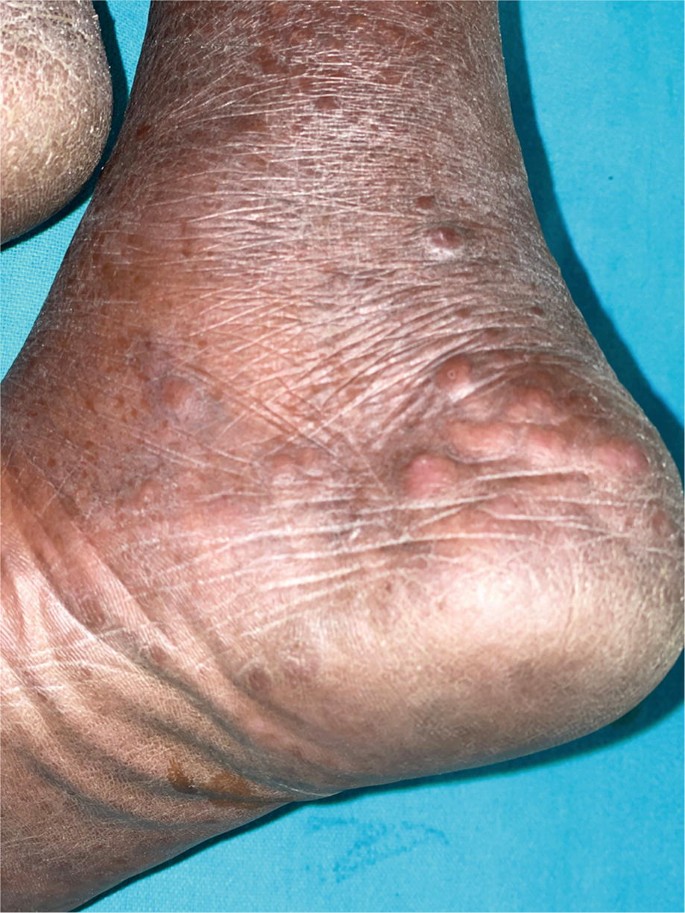 A photo of the heel area of the person has small patches like bumps. It is pale with a dark border with uneven texture and skin tone.