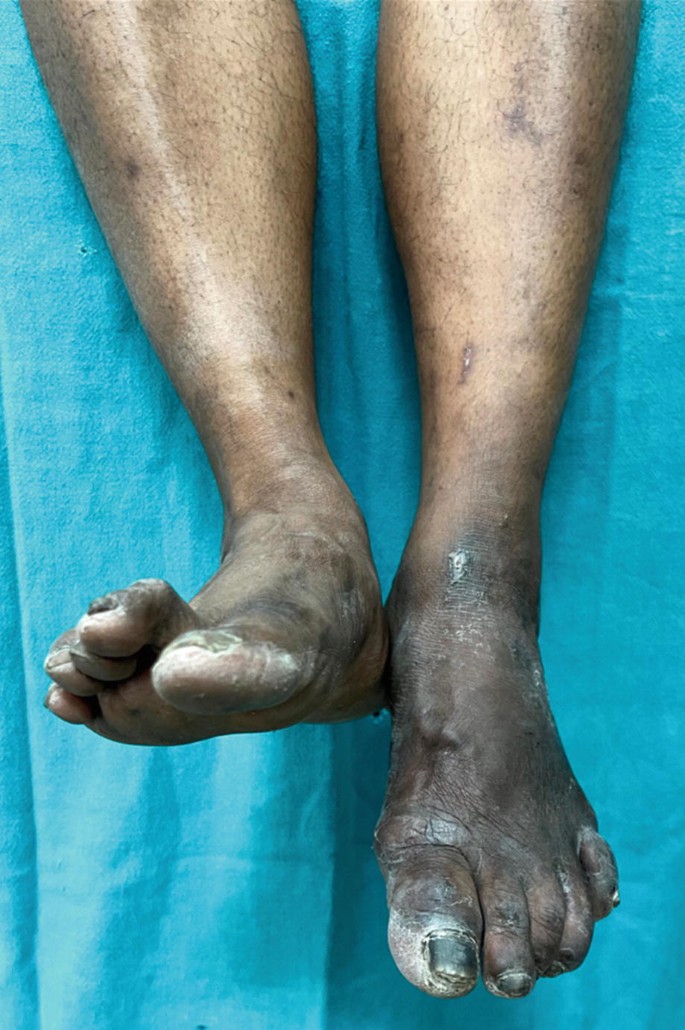A 55-Year-Old Male with Foot Drop and Claw Toes