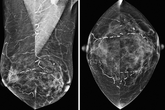 Two mammogram views depict some calcifications. This illustrates B I, R A D S Category 2.