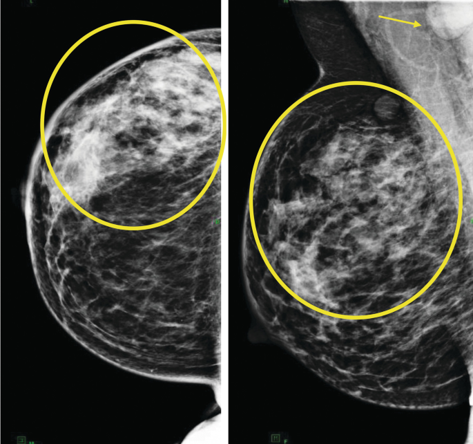 Gross image demonstrating right breast with erythematous areas