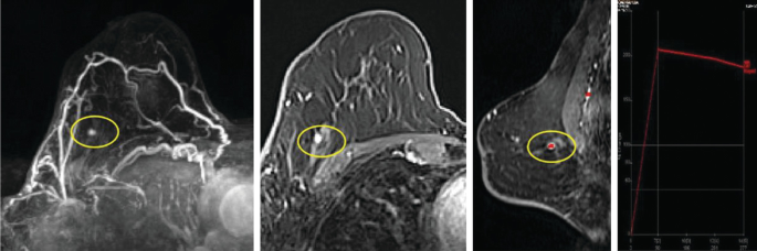 Three M R I scans and a graph. The scans are of a single breast indicating three yellow circles at the same place indicating a small dot whereas the graph shows a long vertical line which bents at 200.