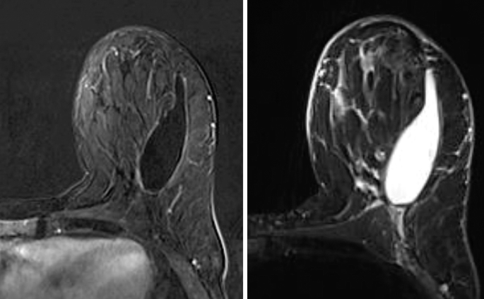 Two blurred M R images of a single breast with an irregular white mass in between surrounded by an irregular gray mass.