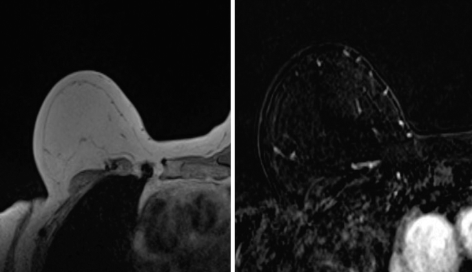 Two images show a single breast. The first picture appears solid and compact, whereas the second one is almost black with some white spots scattered.