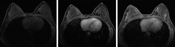 Three M R images of the chest with breast from a vertically upward angle, with more and more clearly indicating a large mass present in between the two breasts.