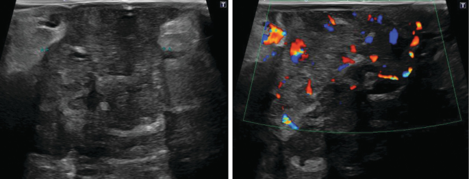 A mammogram and ultrasound image of the breast where one side has a clearly larger light and dense area.