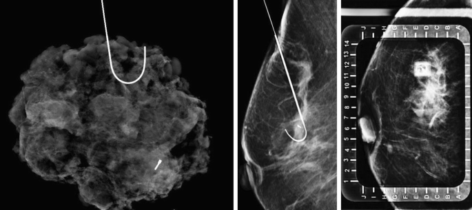 Two mammogram images and an ultrasound image. All three have a visible lump that is detected.