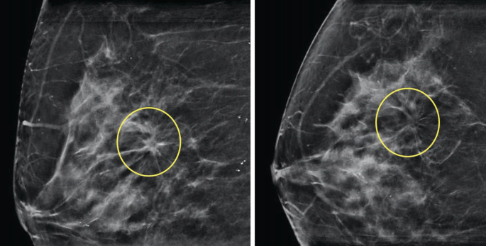 Two mammogram images of a breast from a side perspective. The left image has a slanted curved line in the upper right corner, and on the right image, it has a horizontal curved line near the bottom right corner.