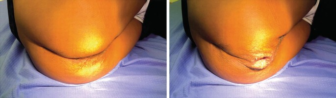 Two photos depict the sagging of the perineum in relaxed and strained semi-prone positions. The first photo indicates a relaxed state while the second photo during strain indicates a wider opening due to muscle sagging.